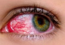 Islamabad(TNS): The outbreak of pinkeye (conjunctivitis) continues to afflict Punjab, with state-run hospitals across the province reporting 500-600 patients, with Lahore topping the list among other districts.