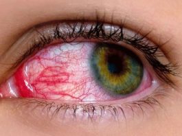 Islamabad(TNS): The outbreak of pinkeye (conjunctivitis) continues to afflict Punjab, with state-run hospitals across the province reporting 500-600 patients, with Lahore topping the list among other districts.